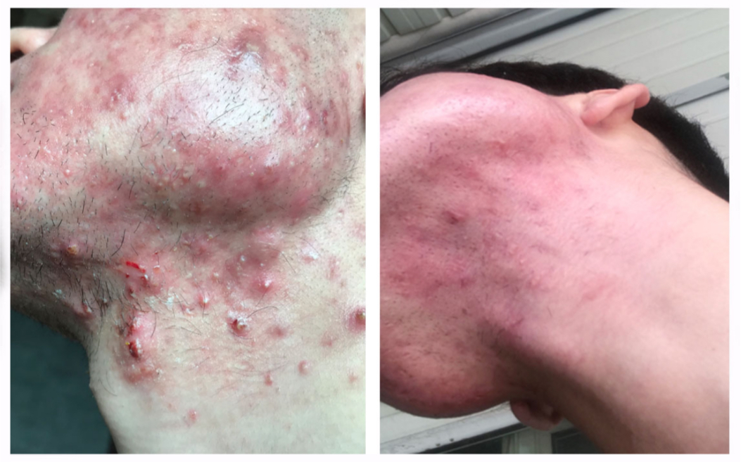 【快速解决淋巴痘痘】简单,快速,高效.