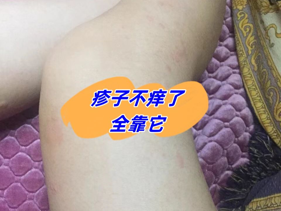 腿上的疹子分分钟消失!我看谁还不知道这个去湿疹法!