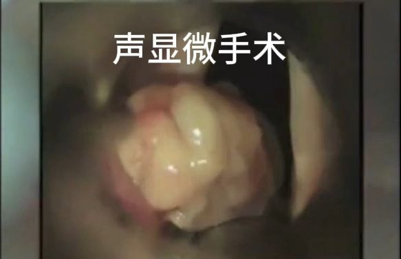 14披裂肉芽肿哔哩哔哩bilibili