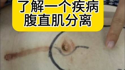 了解一下什么是产后腹直肌分离.该病往往伴有脐疝.