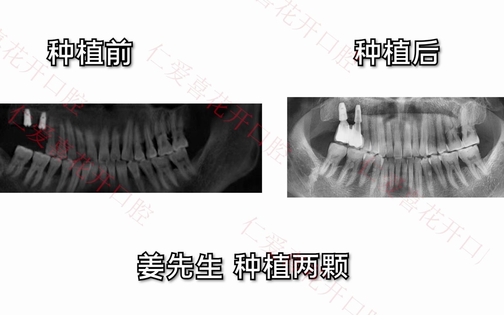 一颗种植牙,要用一辈子! #武汉仁爱医院喜花开口腔# 精准种植,好牙好口福哔哩哔哩bilibili