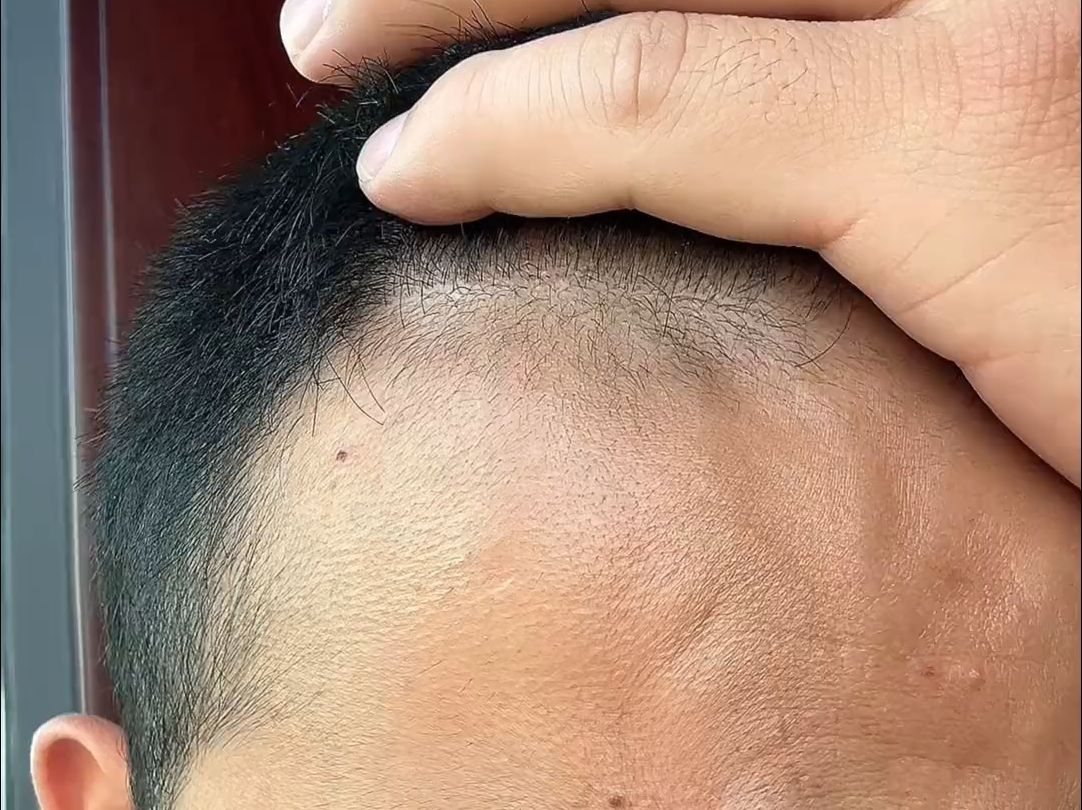 用爸爸植发(植发可以用父母的毛囊吗)