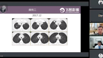 [图]气管壁弥漫性增厚2例