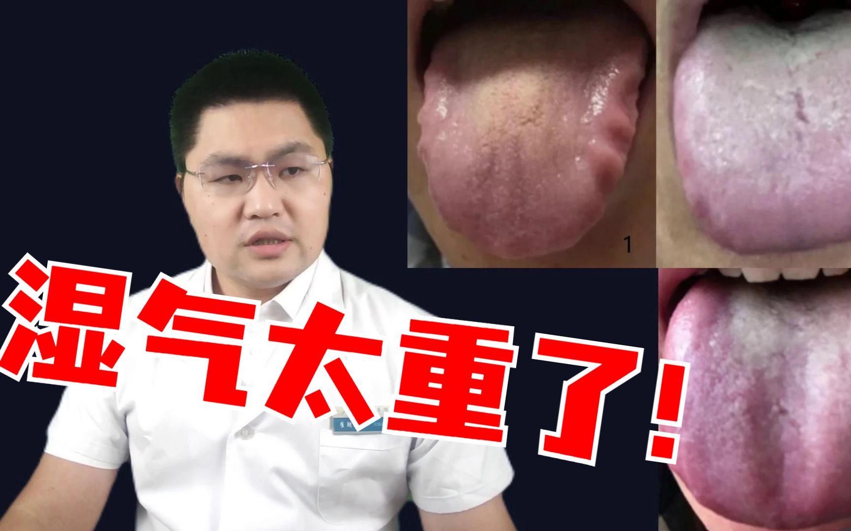 舌诊分析:齿痕舌、胖大舌、厚腻舌,湿气太重了!哔哩哔哩bilibili