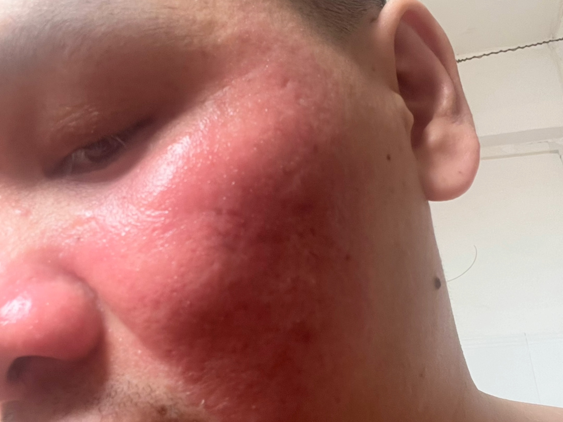 距离三个月现在过去了半个月,左脸颊的痘痘不见了,较深明显的痘坑也