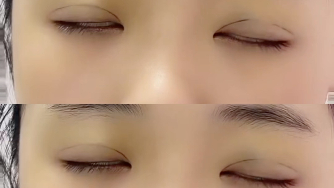 纳米无痕双眼皮