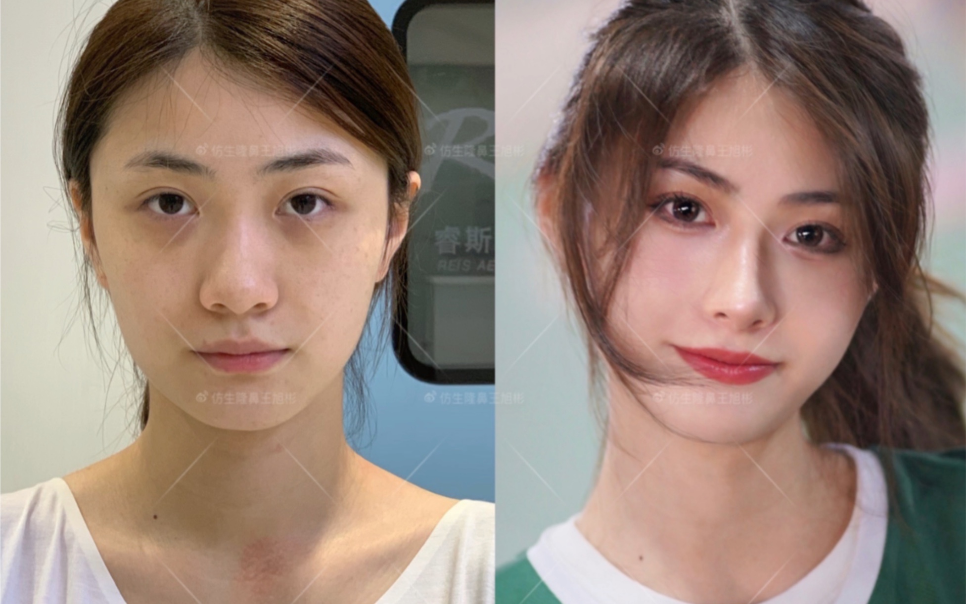 鼻子微调后,这是多少男生心中的白月光啊!王旭彬