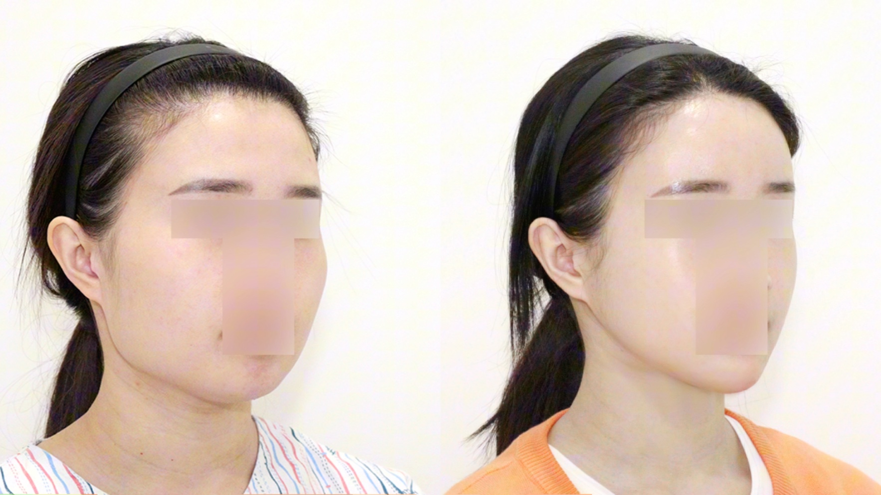 韩国1%轮廓三件套