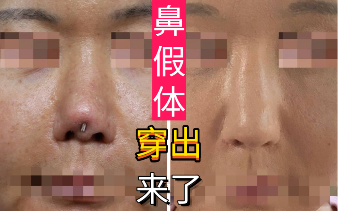 鼻假体穿出的情况见过吗隆鼻术后失败的典型之一就是术后假体穿出这种