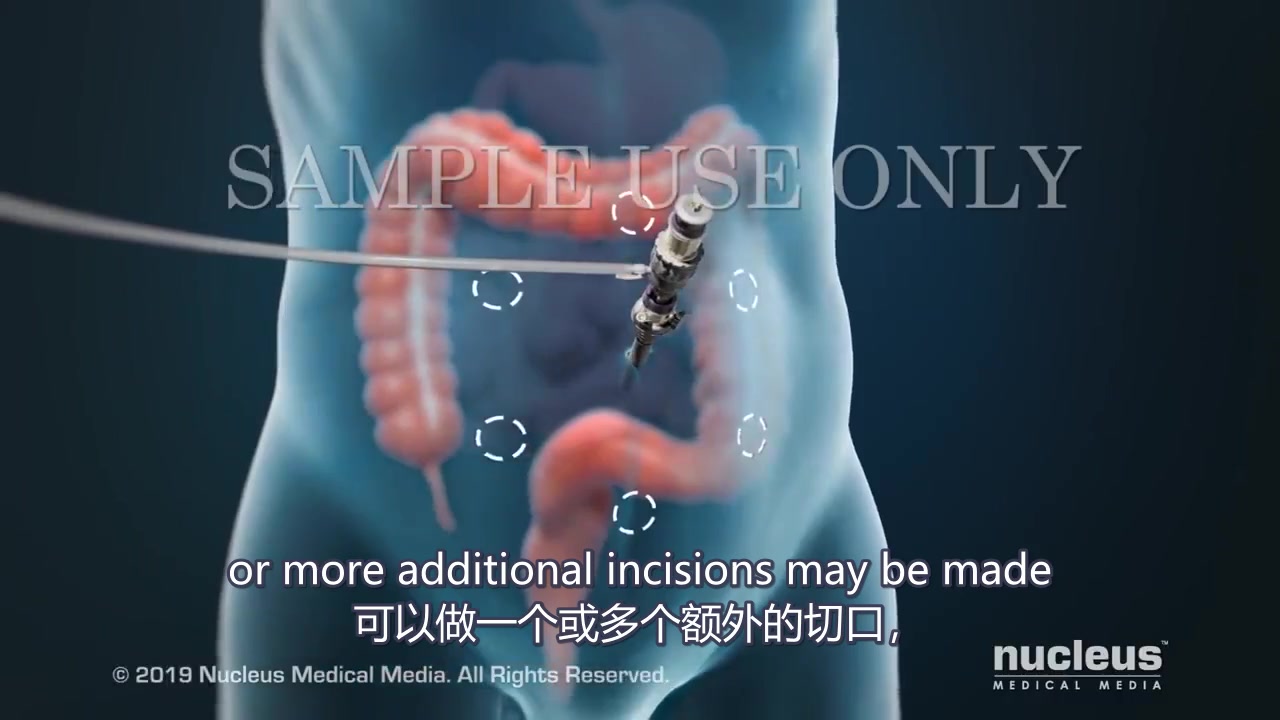 【Nucleus医学科普】腹腔镜下结肠切除术哔哩哔哩bilibili