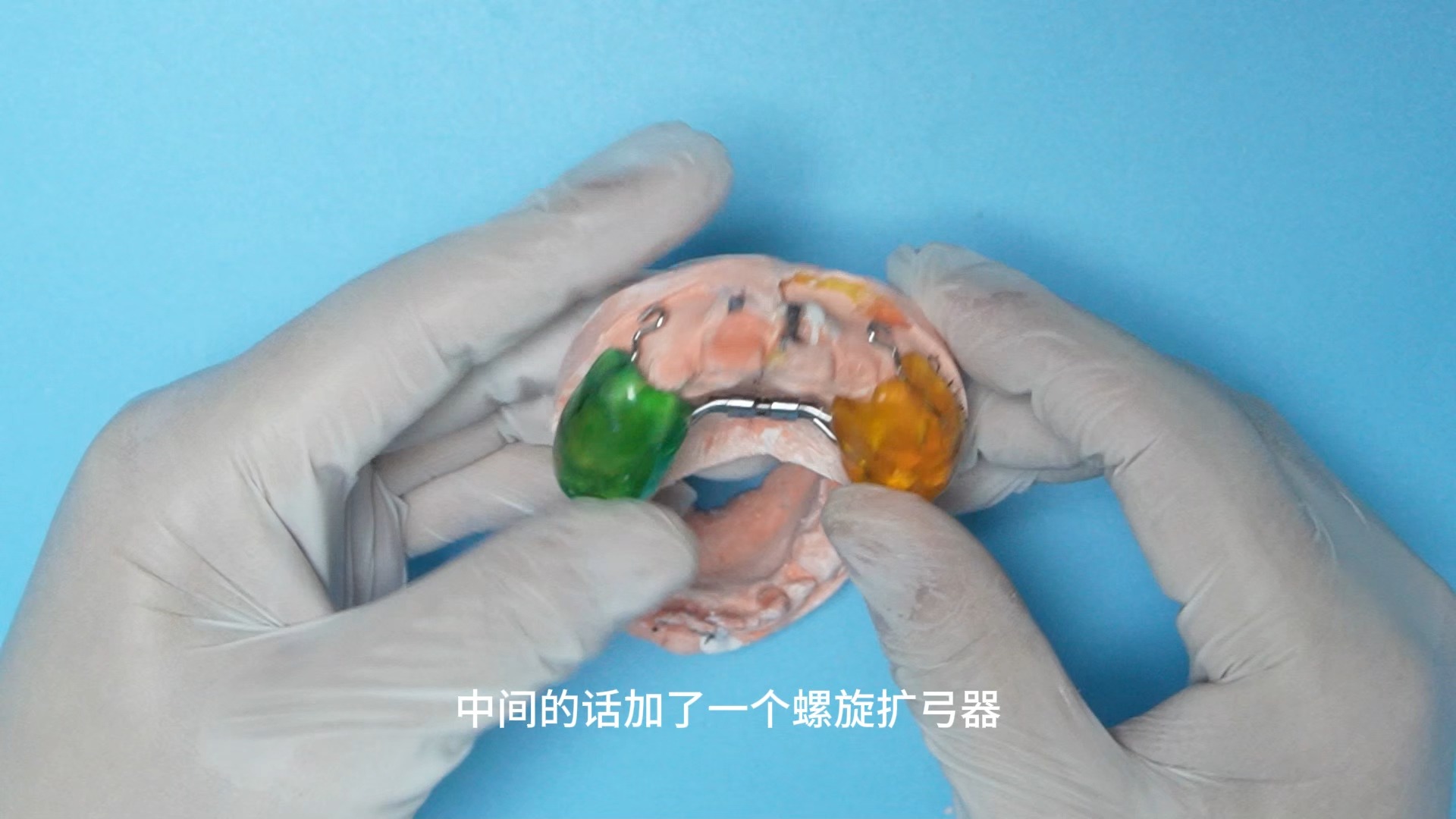 带螺旋扩弓的固定式前牵矫正器 妃她正畸 儿童牙齿矫正器