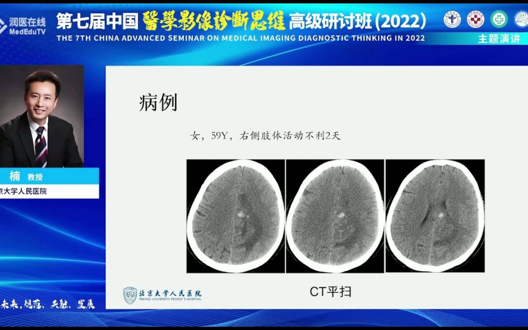 脑内环形强化病灶影像学诊断思路洪楠哔哩哔哩bilibili