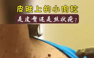 Download Video: 颈部、腋下小肉粒的成因，皮赘的秘密大揭露！