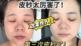 第三次皮秒啦！黑科技真的很厉害！（上集）