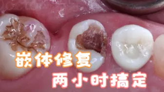 科普嵌体知识：十几天的工程两小时搞定，椅旁嵌体立刻修复不是梦