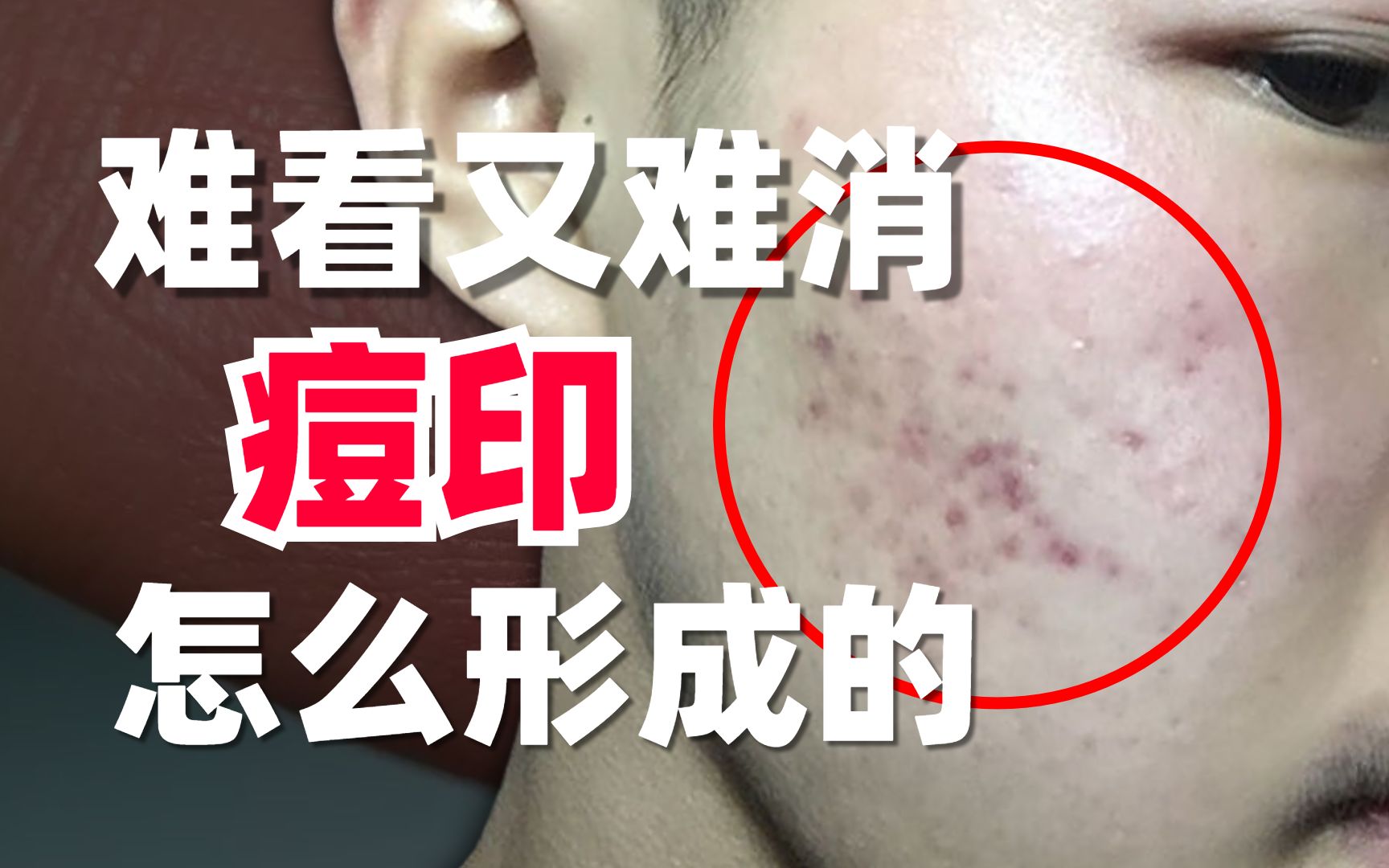 【科普】烦人的红黑痘印,到底是怎样形成的?