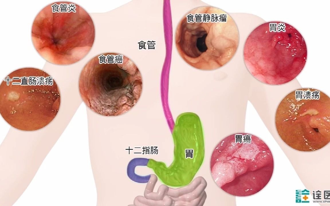 胃镜可以检查什么病?哪些人群需要查?哔哩哔哩bilibili