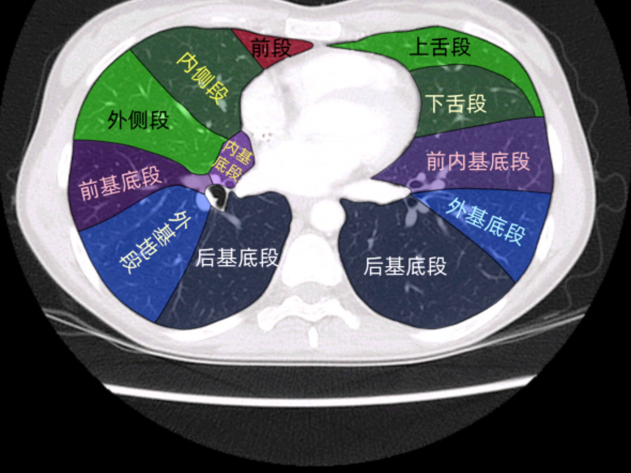 胸部ct肺叶分段
