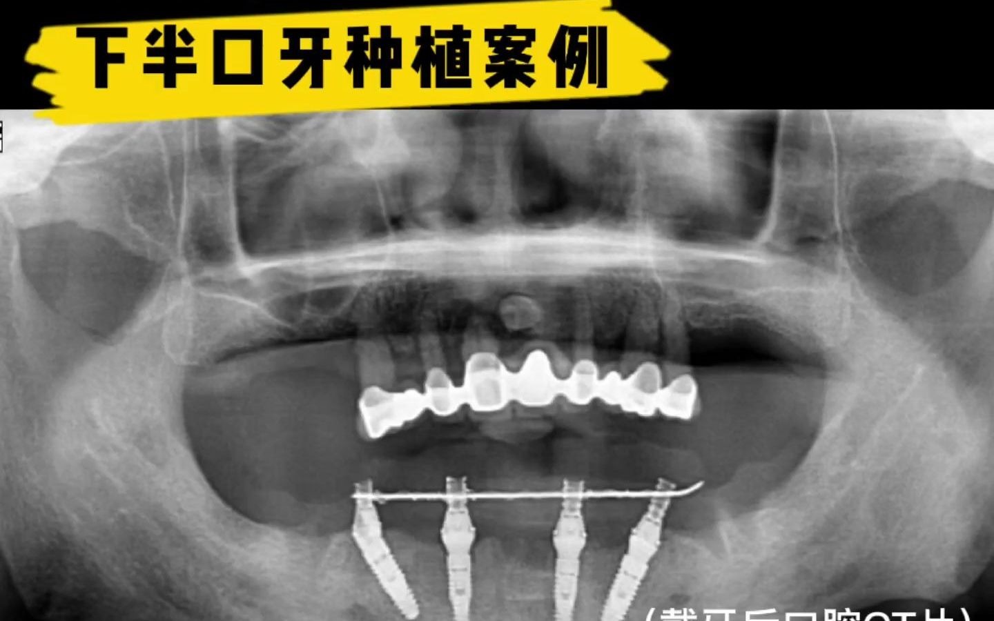 太原种植牙李勇:种植4颗牙,修复半口牙哔哩哔哩bilibili