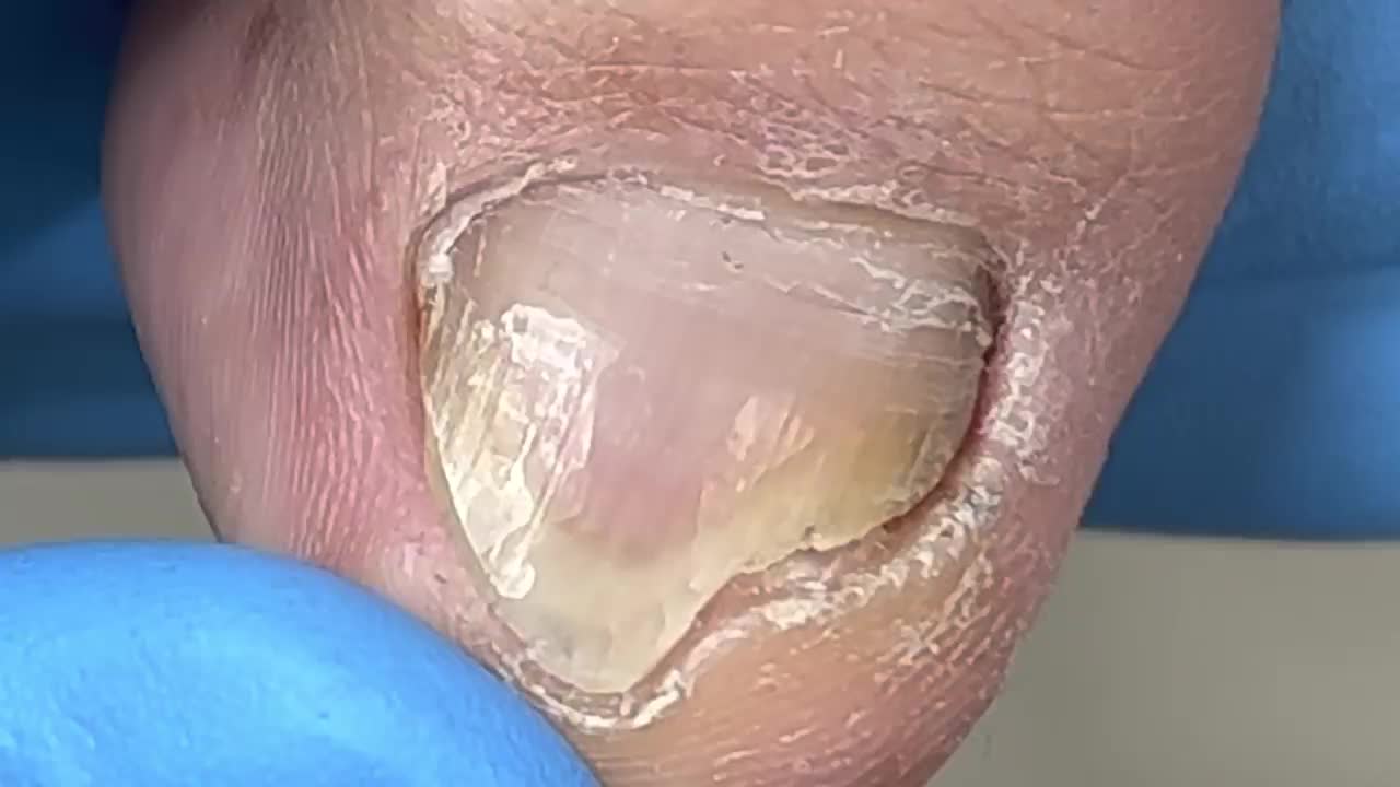 三角灰指甲,剪掉坏指甲