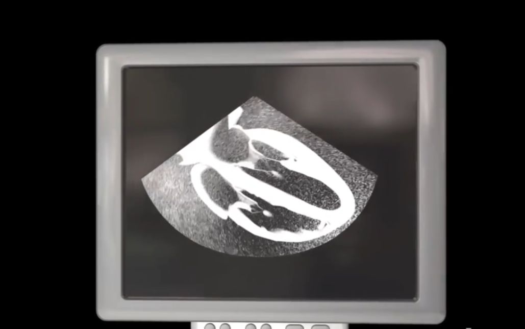 【3d演示】超声心动图(原版 字幕版)_趣味科普人文_科技_哔哩哔哩