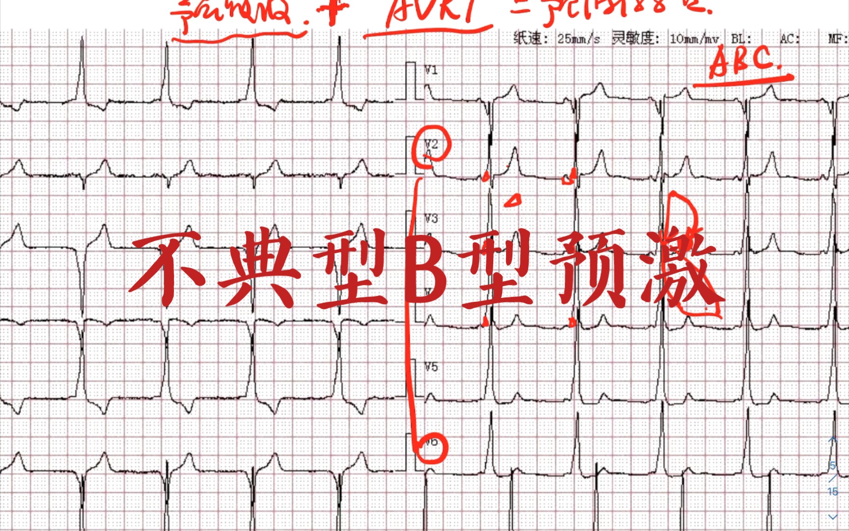 心室预激b型图片