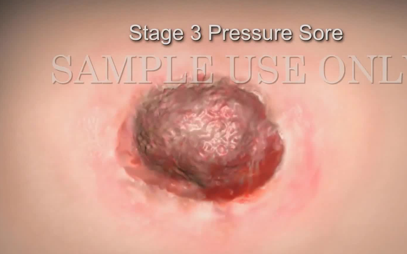 [图]【3D医学动画】压疮的发生机制和分类（中英双字幕）