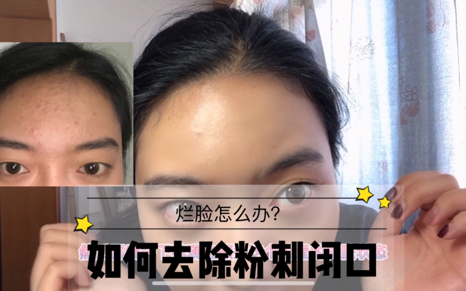 【如何去除粉刺闭口】我与之抗衡了一年!怎么去呢看视频 无推广 看视频!好用!有效!哔哩哔哩bilibili