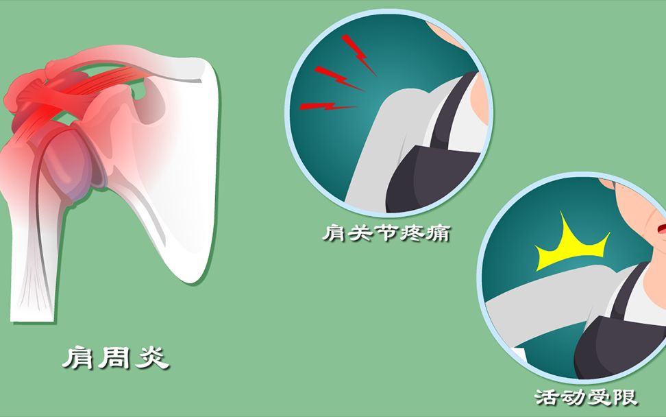 肩周炎2:肩膀疼痛僵硬为那般?哔哩哔哩bilibili