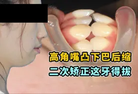 Video herunterladen: 【二次矫正女生】难搞哦！矫正了一年多侧颜竟毫无变化！？二次矫正还能大变样吗？