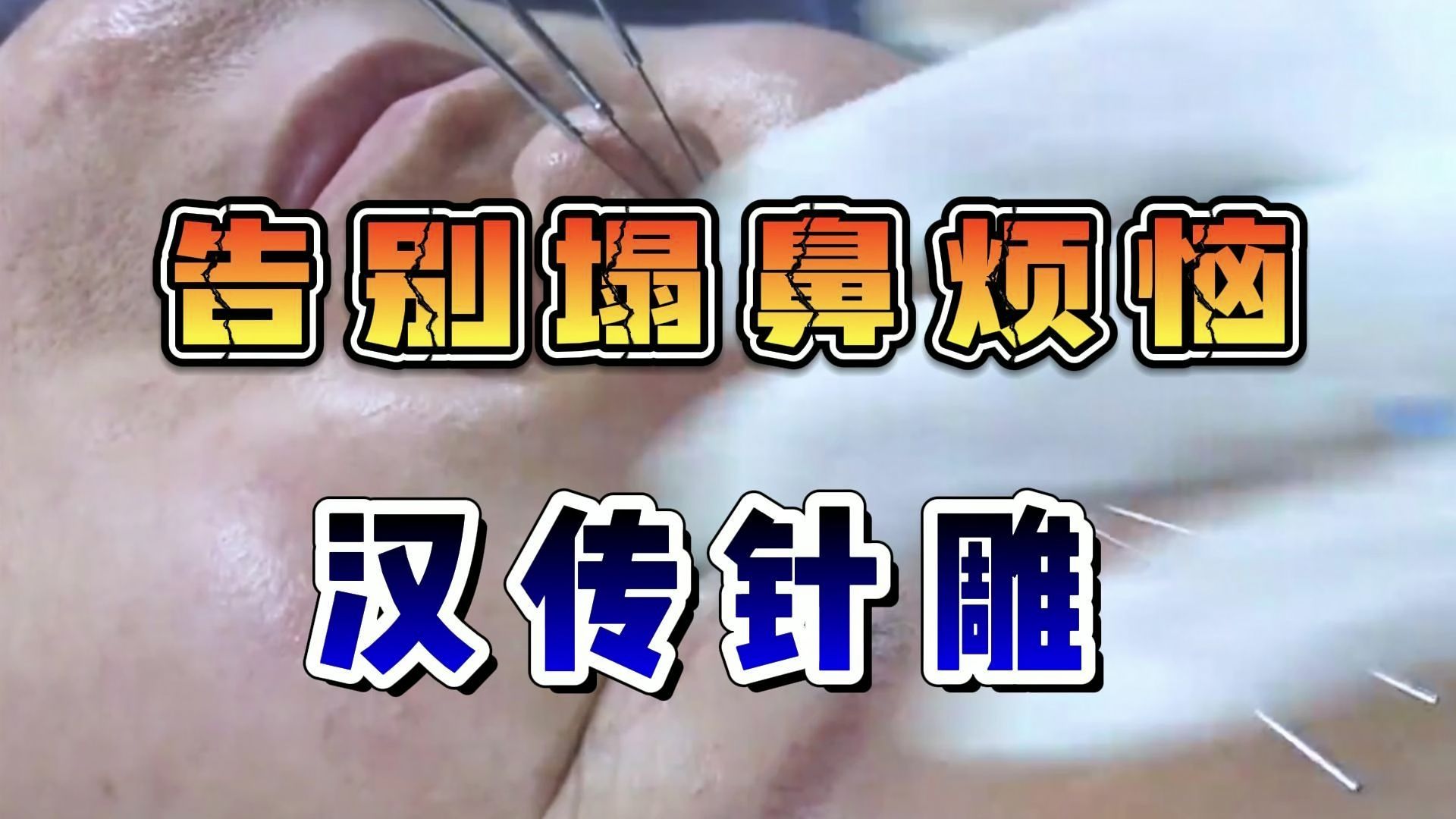 王瑞雪 汉传针雕教学 中医美容 针灸美容 医美 整形