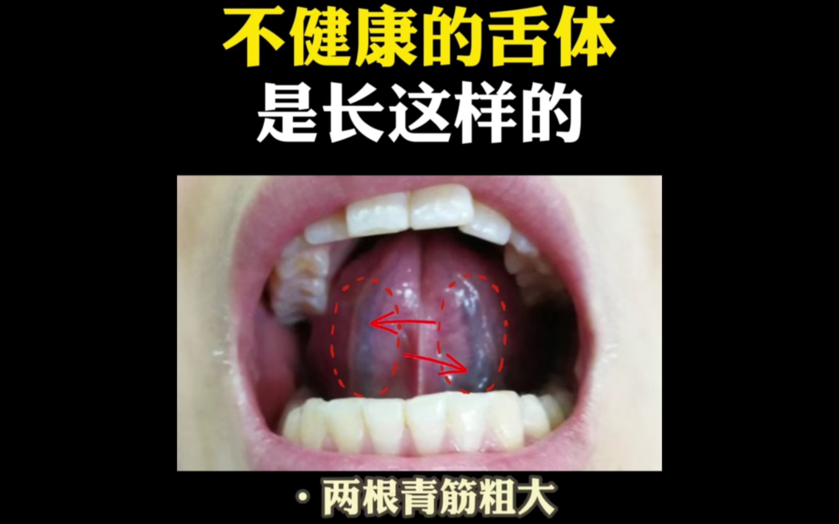 赶紧看看你舌头下面的青筋为什么乌黑!!!哔哩哔哩bilibili