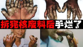 【辐射的烂手】被辐射后肿烂成几倍大，4个小伙自作聪明拆除，完全不知危险性