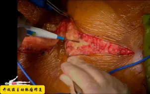 Download Video: 【手术】开放腹主动脉瘤修复