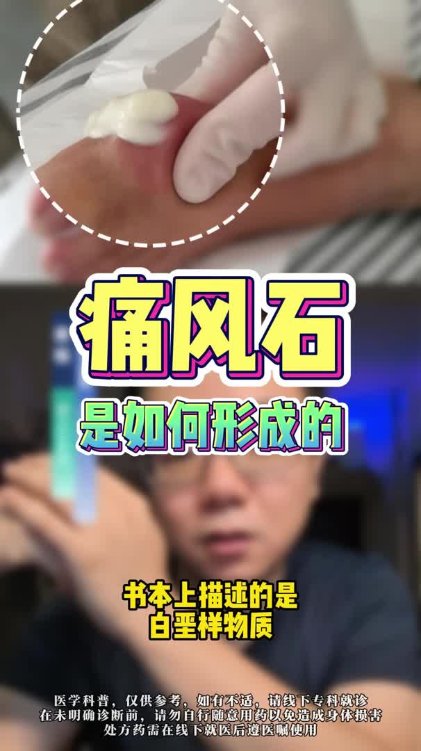 痛风石是如何形成的哔哩哔哩bilibili