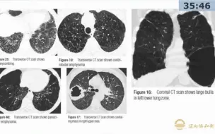 5.囊性病变的鉴别-胸部影像诊断思维训练营系列2