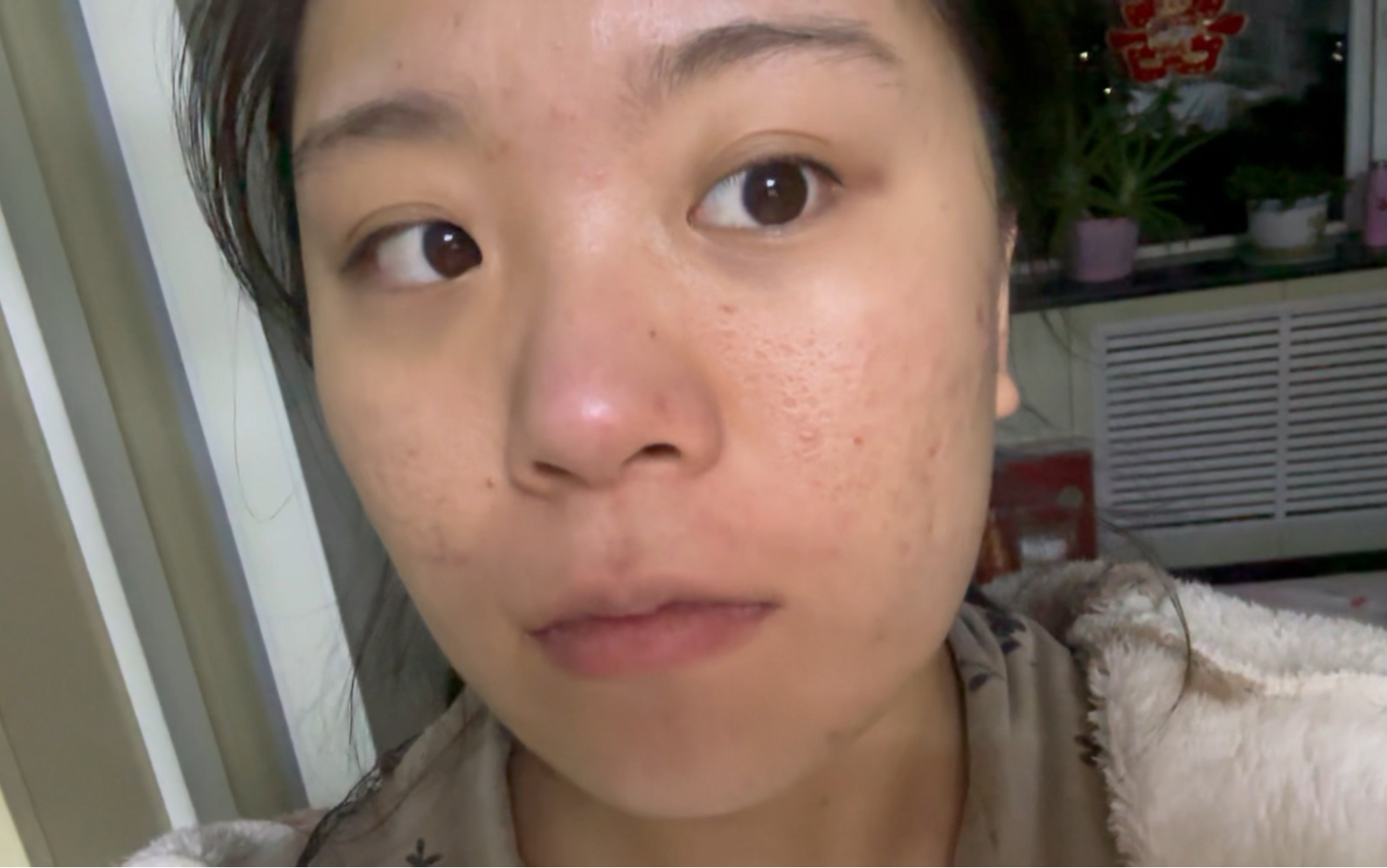 痘坑女孩晚间护肤后 果然不能过度清洁皮肤,随后晚上就长痘好几个