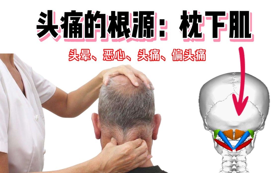 [图]大多数的偏头痛，都是因为枕下肌过度紧张！