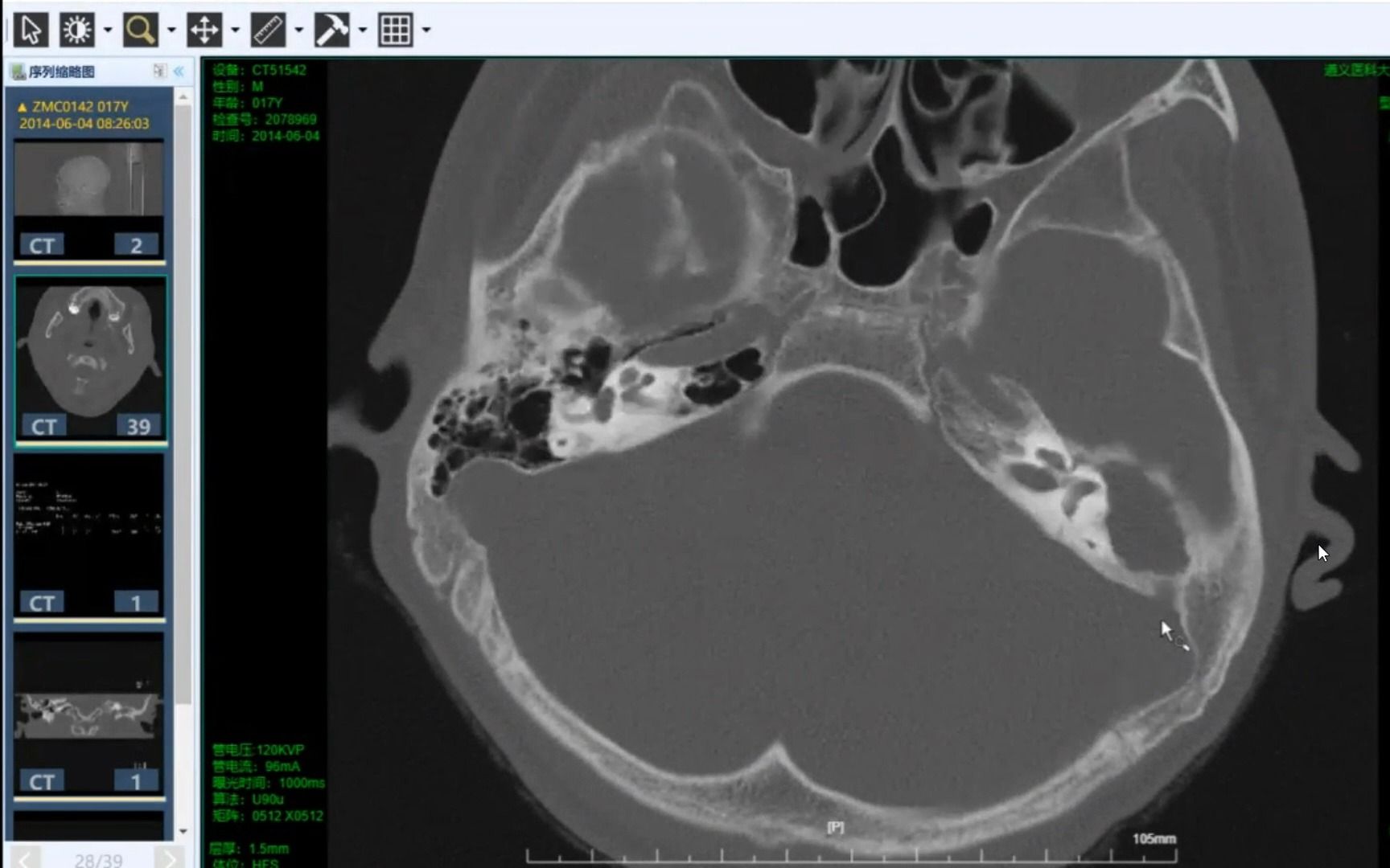 我院通过显微镜下“开放式乳突根治术+鼓室成形术”治愈中耳炎_治疗