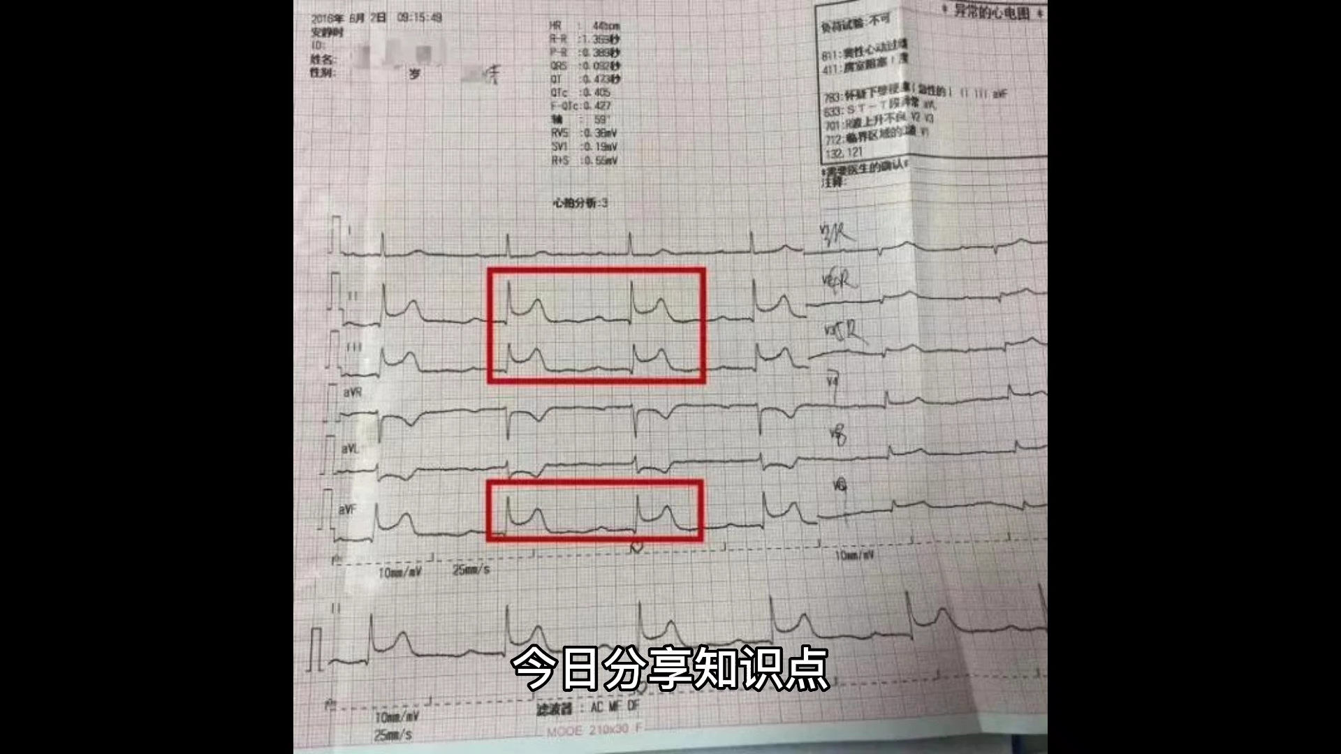 [图]急性下壁心肌梗死最易合并房室传导阻滞。