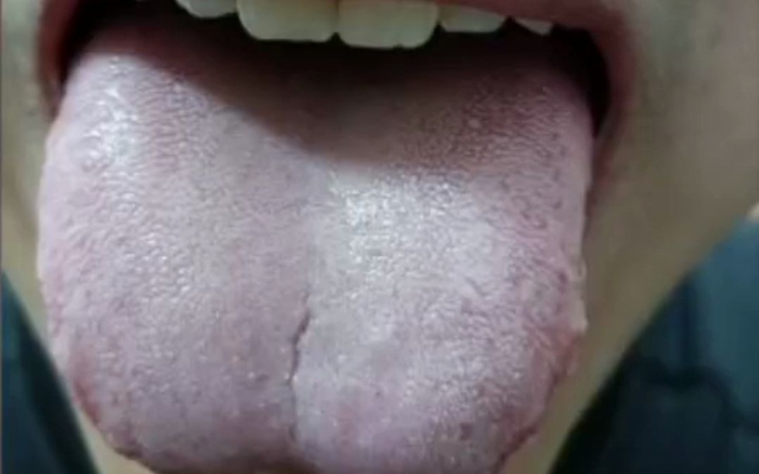 脾胃虚弱舌苔症状图图片