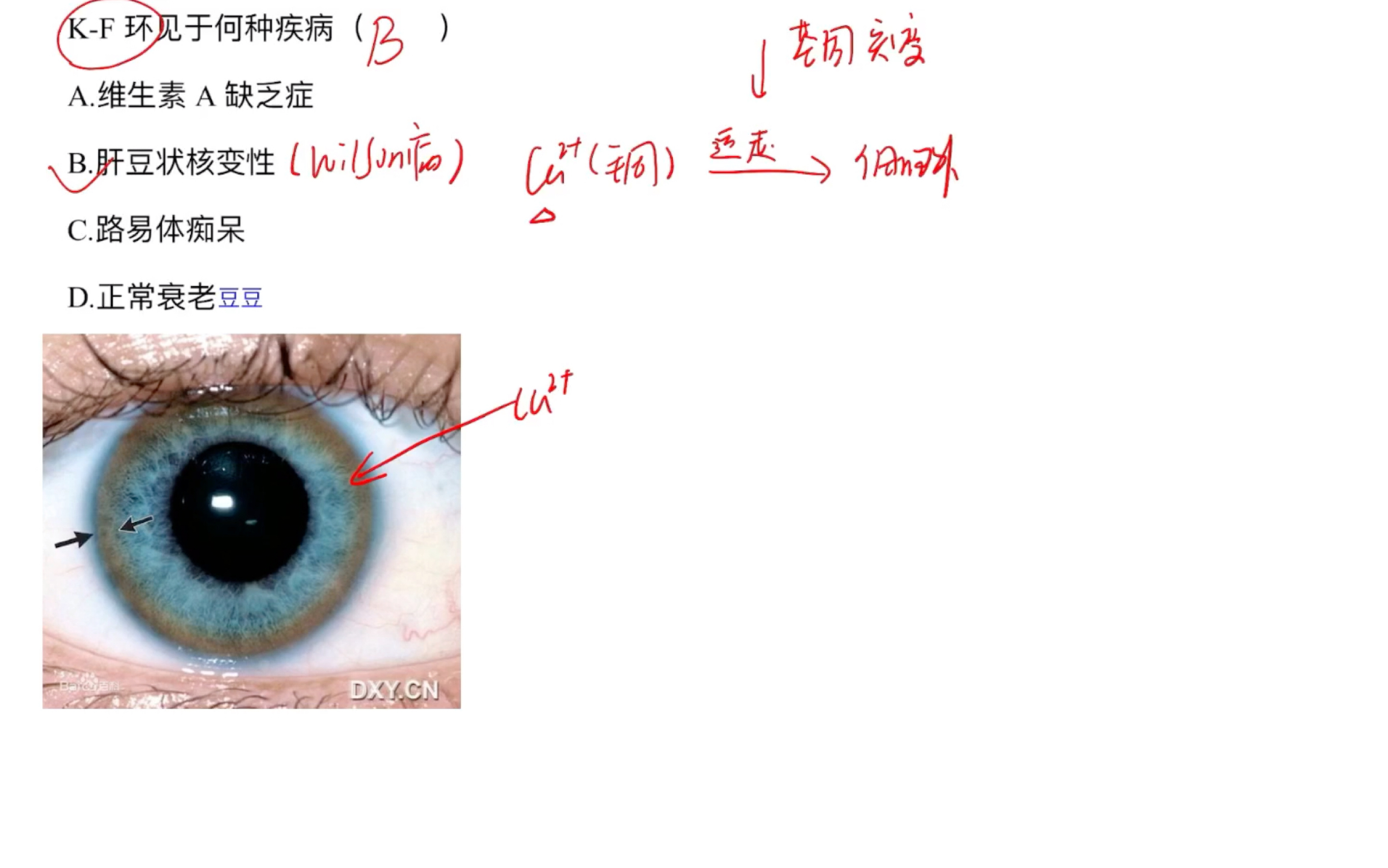 2024考研西綜《診斷學》角膜k-f環和瞳孔變大縮小是絕對重點哈.