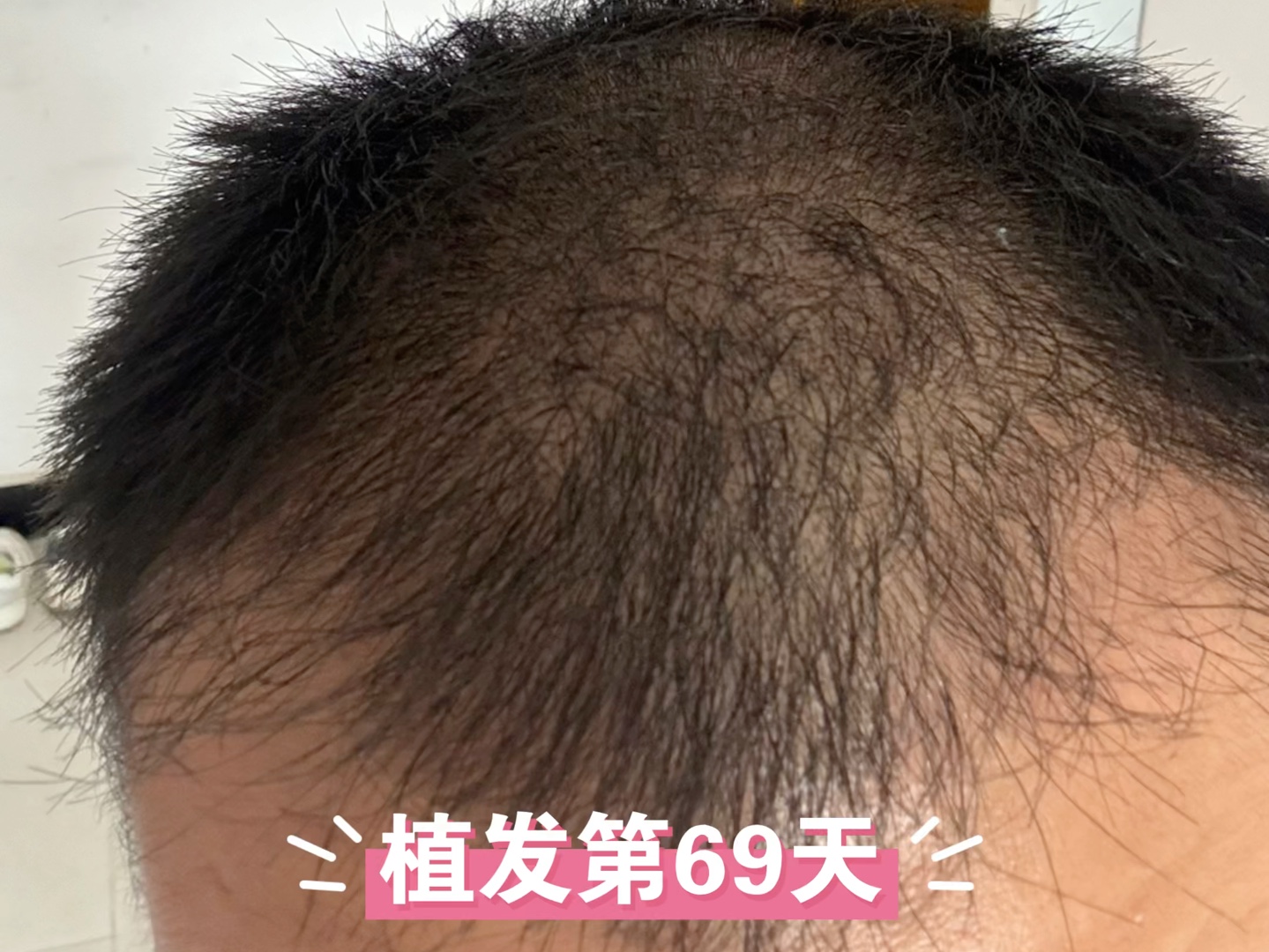 植发植发六个月(植发六个月后还会继续浓密吗)