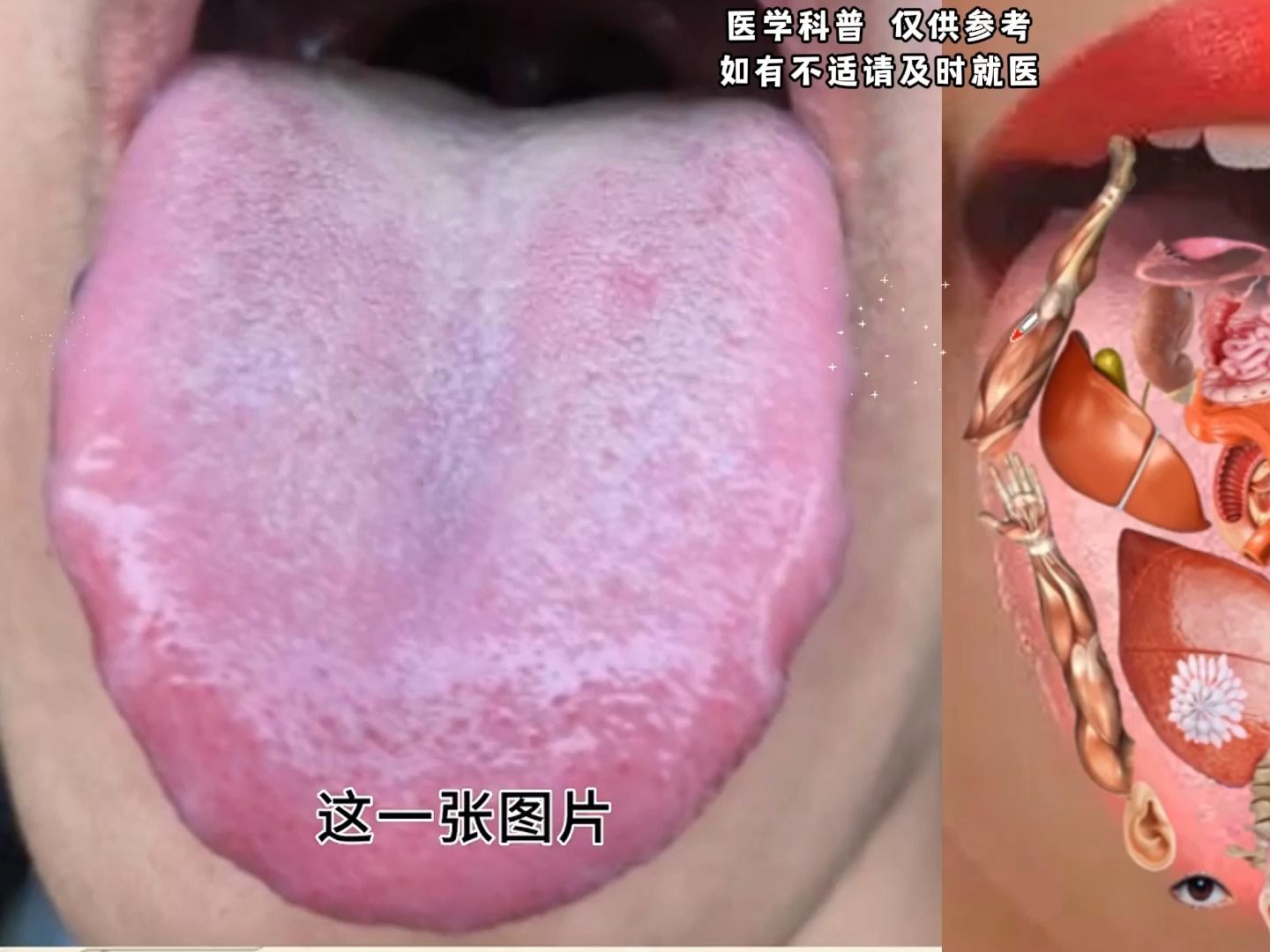 舌象分析:舌尖红,舌边有齿痕,心火旺,脾肾阳虚,睡不踏实!