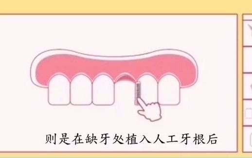 种植牙和固定牙桥的区别「大连齿医生口腔种植中心」「大连口腔医院」「大连种牙价格」「大连种植牙齿」「种一颗牙多少钱」「满口种牙费用」「全口假...