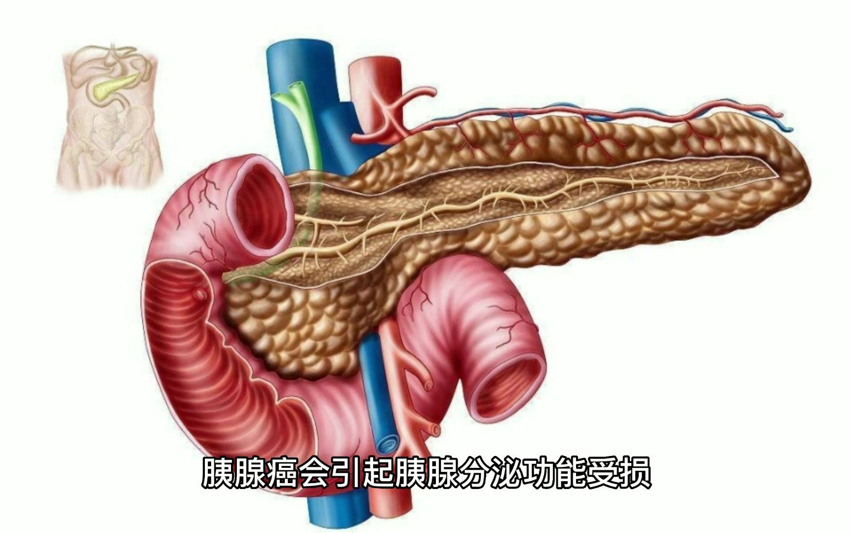 胰腺癌早期症状及诊断方法哔哩哔哩bilibili