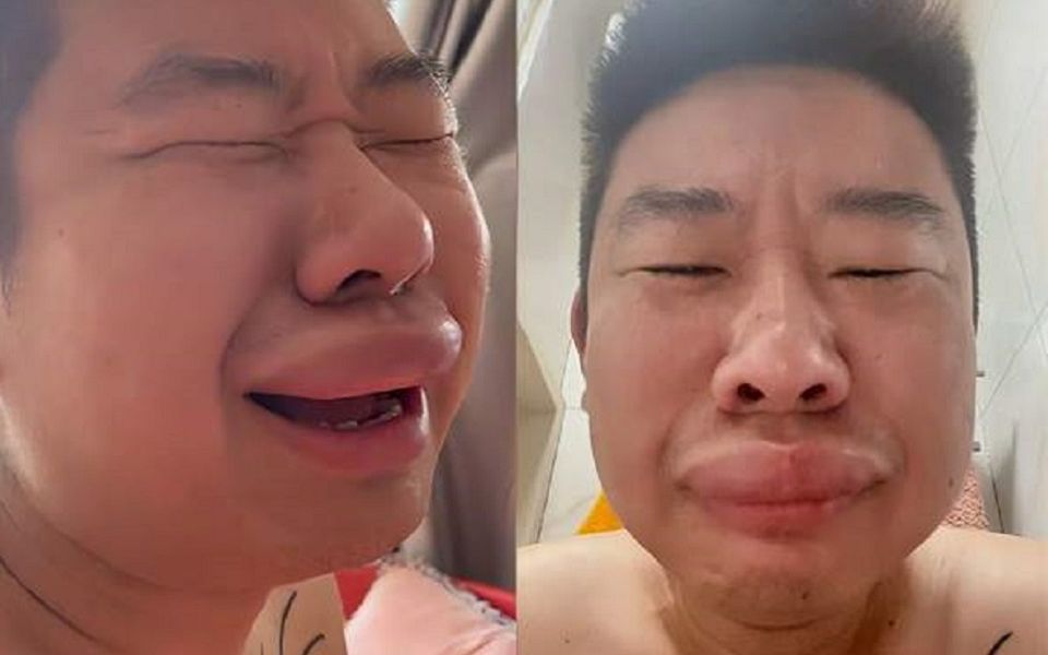 男子嘴唇被蚊子叮成可达鸭手机解锁失败崩溃大喊咋整啊