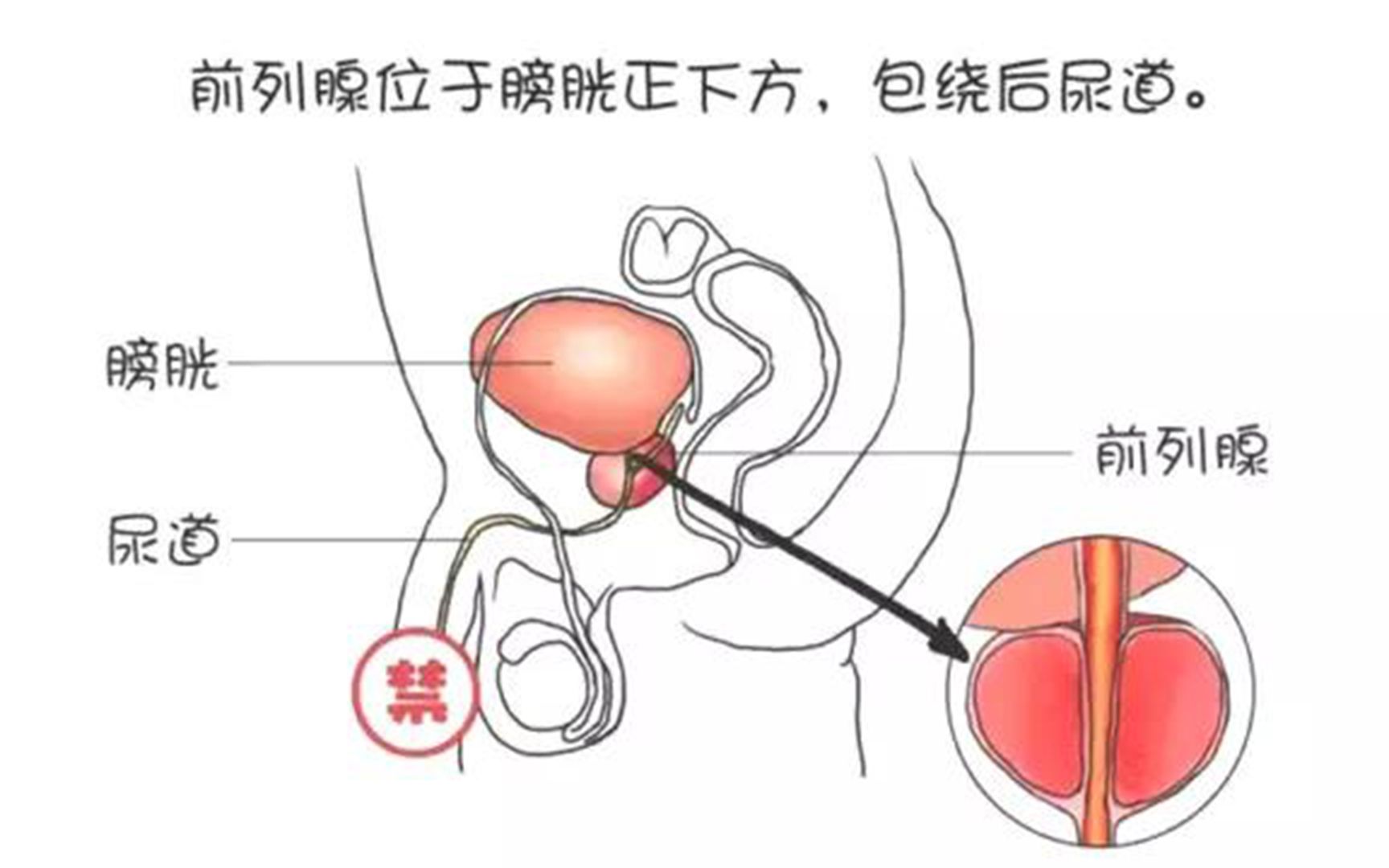 口服左氧氟沙星能治疗慢性前列腺炎吗?哔哩哔哩bilibili