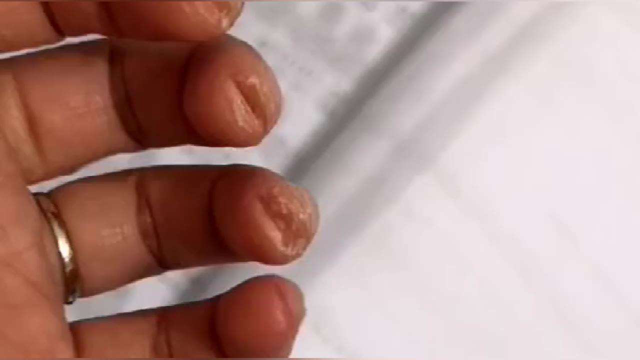 该坚持还是放弃?弹琴把手指头弹变形了