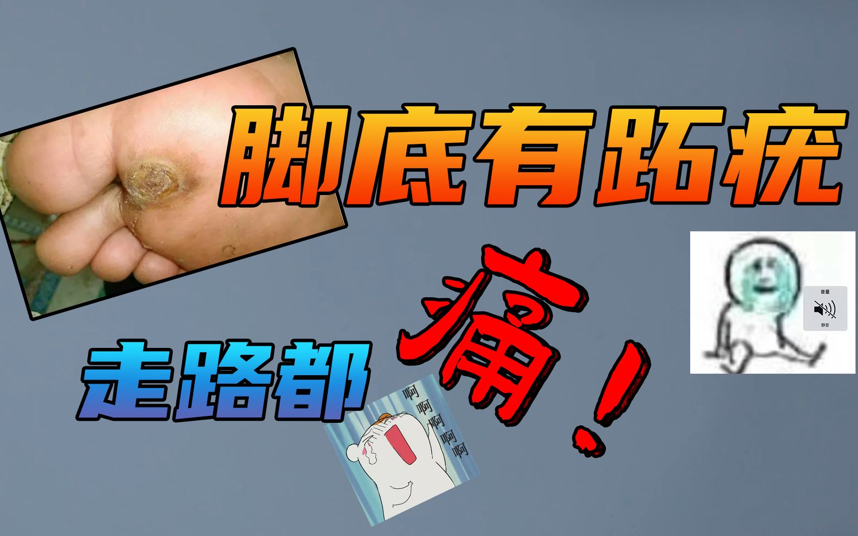 脚上长了一个小“疙瘩”,走路就疼?该怎么治疗呢?哔哩哔哩bilibili